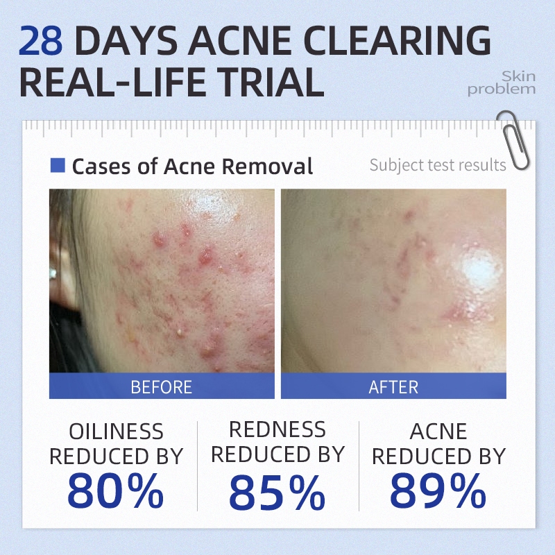 ICE LERSKIN Face Serum Reduce Pores Fading Dark Spots Serum Clean Acne